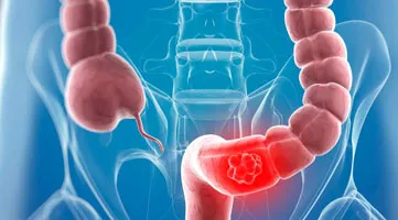 colon are diverticula usual location