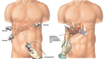 GALLSTONES